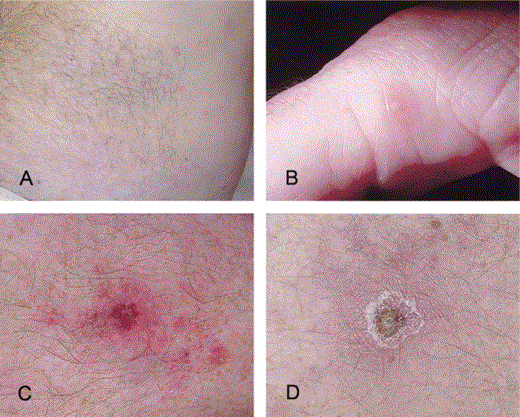 Cutaneous lesions in a patient infected with Rickettsia parkeri. A, A diffuse, pink macular rash involving the abdomen. B, A small pustule on the medial aspect of the first digit. C and D, Eschars located on the pretibial aspects of the right and left lower legs, respectively.
