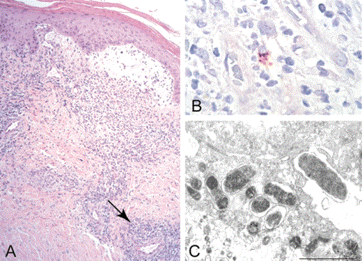 Histopathologic and immunohistochemical evaluation of a biopsy specimen from the margin of an eschar, and ultrastructure of Rickettsia parkeri (strain Portsmouth) isolated in cell culture. A, Lymphohistiocytic perivascular infiltrates (arrow, representative focus) involving the superficial and deep dermis, and subepidermal blistering at the periphery of the eschar represented grossly in figure 1D (hematoxylin and eosin stain; original magnification ×25). B, Immunohistochemical staining of SFG rickettsiae (red) in the cytoplasm of a cell in a focus of perivascular inflammation (immunoalkaline phosphatase with naphthol-fast red substrate and hematoxylin counterstain; original magnification ×250). C, Ovoid and rod-shaped bacteria in the cytoplasm of a Vero E6 cell (an electron micrograph; uranyl acetate and lead citrate stain; bar equals 1 µm).