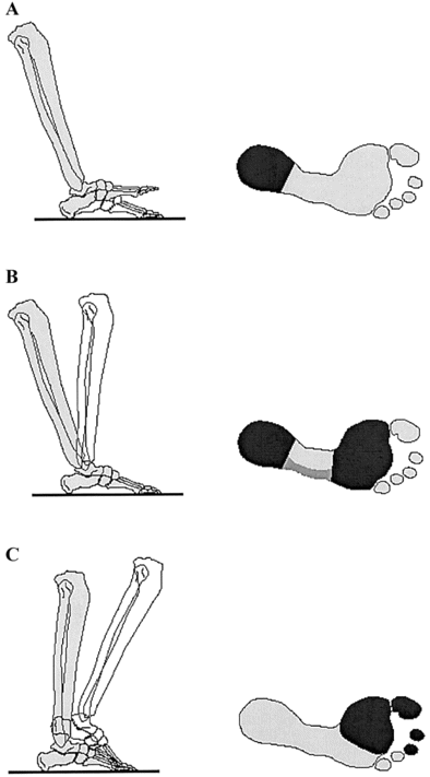 Rollover of the foot during gait and changes in the size and location of the plantar contact surface. The foot first rotates around the heel (heel rocker; A), then the ankle (ankle rocker; B), and then the metatarsal heads and toes (forefoot rocker; C). The plantar contact surface is shown at right (dark).