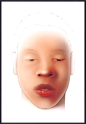 Artist's rendition of an adult patient with mild botulism. Note ptosis and facial paralysis, manifesting as youthful, unlined, and seemingly inexpressive facies. The patient is fully alert. (Illustrator, James K. Archer).