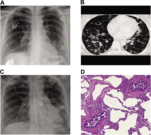 Imaging and lung pathology from the patient. A chest radiograph (A) obtained at admission revealed bilateral reticulonodular infiltrates with associated lower lobe consolidations, whereas a CT scan (representative slice; B) showed bilateral centrilobular nodules with a tree-in-bud appearance suggestive of bronchiolitis. After intubation, a chest radiograph was performed on the patient on hospital day 4 that revealed persistent bilateral infiltrates (C). On day 7 after hospital admission, findings from lung biopsy analysis revealed an organizing bronchiolitis but no direct histological evidence of virus infection (hematoxylin and eosin stain, low magnification; D).
