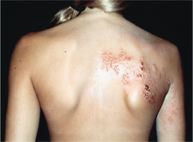 Thoracic herpes zoster (photograph provided by S.W.W.)