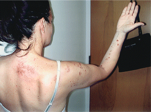 Cervical herpes zoster (photograph provided by A.L.O.)