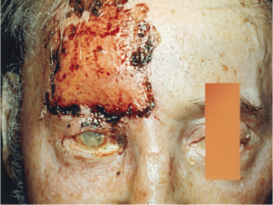 Herpes zoster ophthalmicus (photograph provided by D.P.-L.)
