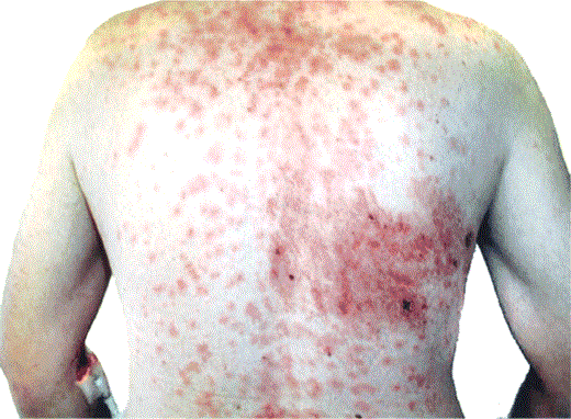 Disseminated herpes zoster (photograph provided by S.K.T.)