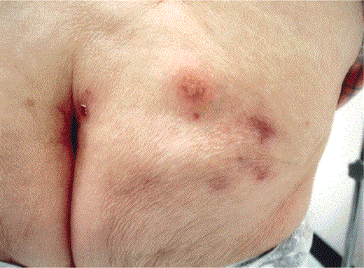 Zosteriform herpes simplex in an elderly woman who presented with what she called “her recurrent shingles.” Vesicles in a lumbosacral distribution had recurred many times over the past several years, and this outbreak began 1 week before the photo was taken. A viral culture demonstrated herpes simplex virus type 2. The patient was otherwise healthy, except for hypertension (photograph provided by S.K.T.).