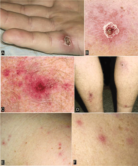 Cutaneous lesions from patients with confirmed Rickettsia parkeri rickettsiosis. Inoculation eschars, representing the site of primary infection following a bite from an R. parkeri–infected tick, are present on the lateral aspect of the palm of patient 5 (A) and on the lower extremities of patient 4 (B–D). These lesions are 0.5–1.5 cm wide, with a central area of ulcerated or scabbed skin surrounded by a halo of erythema (A and B) or petechiae (C). Panel D shows multiple eschars on patient 4. The rash of R. parkeri rickettsiosis, as seen on patients 4 (E) and 5 (F), is a maculopapular or papulovesicular eruption on the trunk and extremities, occasionally involving the palms and soles.
