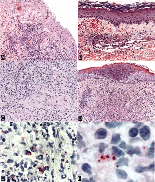 Histopathological and immunohistochemical characteristics of eschars (A–C and F) and rash lesions (D and E) of patients with Rickettsia parkeri rickettsiosis. A, Denuded epidermis with dermal necrosis and mixed inflammatory cell infiltrates (patient 7). B, Lymphocytic vasculitis in a small vessel in the superficial dermis associated with partially occlusive fibrin thrombi and extravasated erythrocytes (patient 1). C, Dense perivascular lymphohistiocytic infiltrates in the deep dermis (patient 5). D, Intraepidermal pustule and extensive neutrophilic and mononuclear inflammatory cell infiltrates associated with necrosis in the middermis. E, Immunohistochemical localization of intact R. parkeri and rickettsial antigens in the cytoplasm of mononuclear cells (patient 6). F, Coccobacillary forms of R. parkeri in mononuclear inflammatory cells in an eschar (patient 7). Hematoxylin and eosin stain (A–D) and alkaline phosphatase with polyclonal anti–R. rickettsii antibody (1:500) and naphthol-fast red, with hematoxylin counterstain (E and F). Original magnifications, ×25 (A and D), ×50 (B), ×100 (C and E), and ×158 (F).
