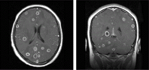Axial (left) and coronal (right) T1-weighted images, with contrast, from 2 different patients showing multiple ring-enhancing lesions throughout the supratentorial brain and cerebellum. There is involvement of the frontal, occipital, and temporal lobes, and basal ganglia lesions are also present. Low signal–intensity edema is noted in association with the larger lesions, resulting in mild local mass effect.