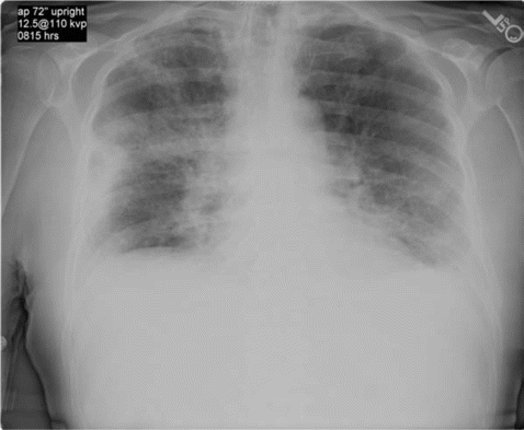 Chest radiography reveals bilateral patchy infiltrates mostly in peripheral lung fields.