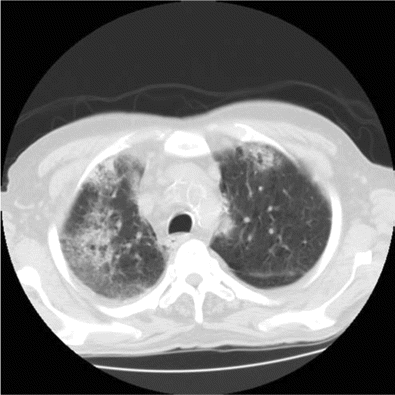 Computed tomography of the chest reveals patchy infiltrates.