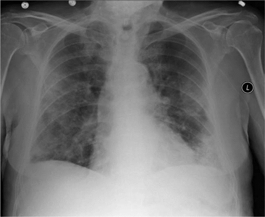 Chest radiography reveals bilateral patchy infiltrates mostly in peripheral lung fields.