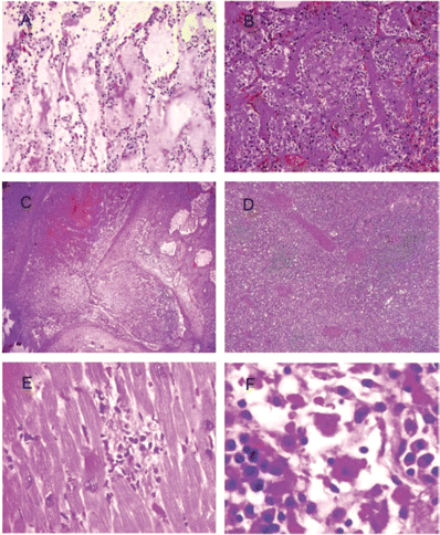 Histopathological changes of pulmonary and extrapulmonary tissue (hematoxylin-eosin stained) of the deceased patients suffering from pandemic influenza A H1N1 2009. A Lung parenchyma showing acute exudative phase of diffuse alveolar damage on day 7 after symptom onset in a 42-year-old previously healthy man with interstitial cellular infiltrate and proteinaceous exudates in alveoli and hyaline membrane formation (original magnification, imes;100). B Lung parenchyma showing chronic fibroproliferative phase of diffuse alveolar damage with marked thickening of the alveolar septa and alveolar space being replaced by fibrogranulation tissues on day 28 of symptom onset in a 37-year-old previously healthy woman (original magnification, imes;200). C Thrombosis of branches of pulmonary artery in the same patient in panel B who died despite extracorporeal membrane oxygenation (original magnification, imes;200). D Lymphoid atrophy with no recognizable germinal centre in the spleen of the same patient in panels B and C. The periarteriolar lymphoid sheath (white pulp), which was markedly reduced in size (original magnification, imes;400). E Myocardium showing a microscopic focus of lymphoid aggregate accompanied by myofibril necrosis in a 58-year-old man presenting with elevated creatine kinase isoenzyme CK-MB and echocardiographic evidence of diastolic dysfunction (original magnification, imes;200). F Mediastinal lymph node showing reactive hemophagocytosis in the same patient in panel E (original magnification, imes;400).