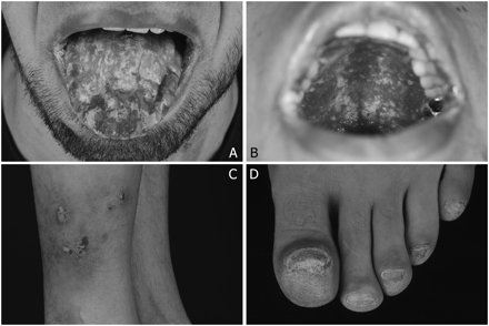 Ulcerative mucositis of the (A) tongue and (B) palate; (C) mycosis of normal skin (right lateral calf) and (D) onychomycosis of all nails.