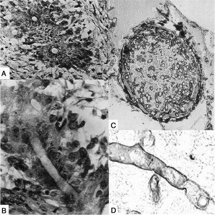 A,Basidiobolus ranarum in hematoxylin-eosin–stained tissue section showing a cross-section of hyphae with sleeves of eosinophilic material. B, Hyphae in longitudinal section in the same tissue shown in A. C, Angioinvasion in mucormycosis. A pulmonary blood vessel occluded by hyphae of Cunninghamella bertholletiae stained with hematoxylin-eosin. D, Hyphae of Rhizopus species in tissue stained by hematoxylin-eosin. Note the lack of eosinophilic material around the hyphae. Images are reproduced from Kwon-Chung and Bennett [33] (scale bar, 10 μm).