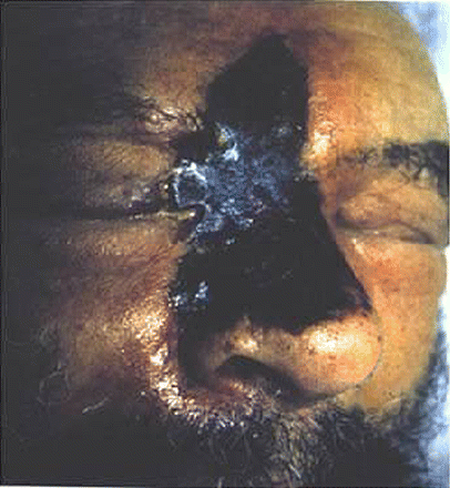 Necrotic facial eschar of a patient with rhinocerebral mucormycosis.