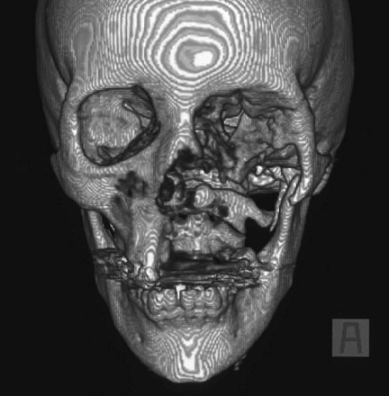 Three-dimensional computed tomographic scan of the facial skeleton of a patient with rhinocerebral mucormycosis showing extensive skeletal defects after orbitomaxillary resection.