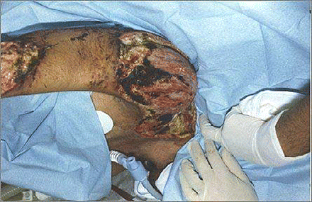 Cutaneous necrotizing mucormycosis of the right upper limb of a burn victim.