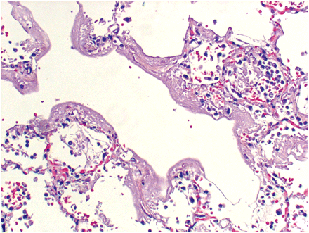 Lung biopsy specimen from a patient with influenzal pneumonia, showing numerous necrotic cells in alveolar spaces, hyaline membranes, destruction of bronchial walls by neutrophils, and intra-alveolar hemorrhage, as well as occasional streptococcus pneumonia in alveolar spaces (kindly provided by Dr Fritz Lin, UCI Department of Pathology).
