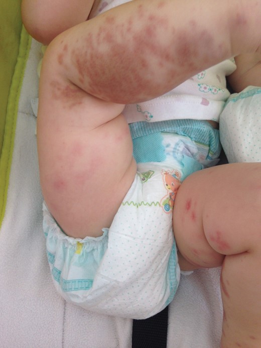 Acute hemorrhagic edema of infancy. Further spreading of purpuric rash with edema over limbs.