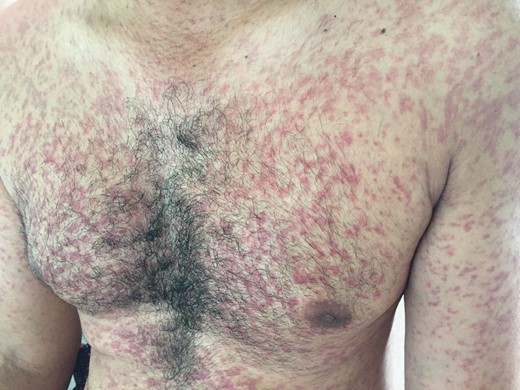 Maculopapular confluent rash over the trunk.