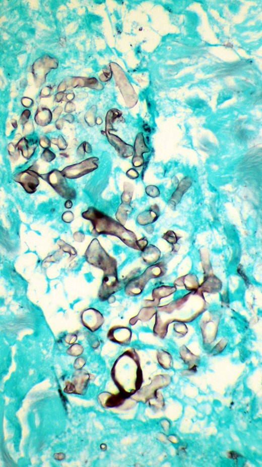 Grocott methenamine silver stain of surgical culture, showing numerous aggregates of fungal hyphae that appeared degenerated, but broad, ribbon-like, and pauciseptate, 400x magnification.