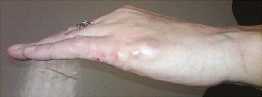 Subcutaneous nodules on the medial aspect of the left little finger and the medial edge of the left hand.