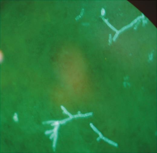 Fluorescent stain of nodule aspirate.