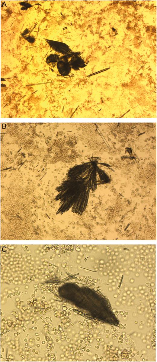 Microscopic examination (magnification 400×) of the urine sediment with needle-shaped crystals.