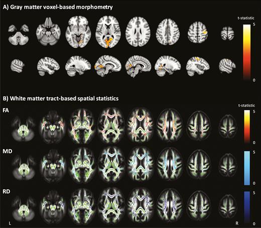 Voxelwise analyses of volumetric and diffusion measures. A, Gray matter voxel-based morphometry group comparison. Areas with significantly (P < .05) lower gray matter volume colored by t-statistic (red/yellow), corrected for multiple comparisons and adjusted for age, intracranial volume, and scanner. Significant differences are overlaid on the Montreal Neurological Institute 152 T1 brain image. B, White matter tract-based spatial statistics group comparison. Areas of significantly (P < .05) lower fractional anisotropy (FA), higher mean diffusivity (MD), and higher radial diffusivity (RD) are colored red-yellow, light blue, and dark blue, respectively, by t-statistic, corrected for multiple comparisons, and adjusted for age, intracranial volume, and scanner. Significant differences overlaid on the white matter skeleton (green) and the mean fractional anisotropy image (grayscale).