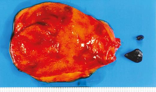 Resected gallbladder and removed black stones.