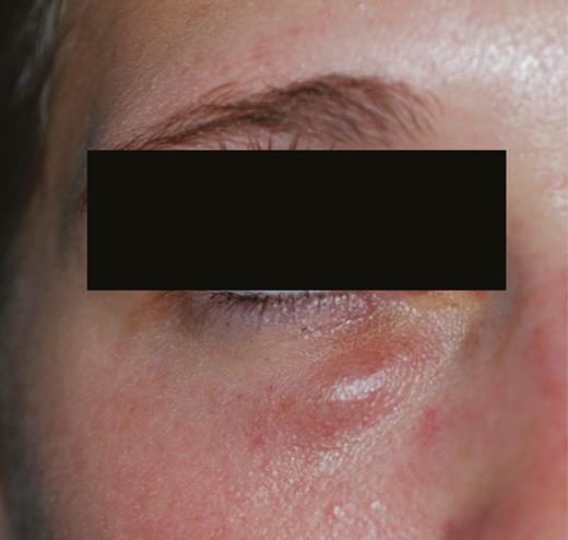Swelling of the right lower eyelid.