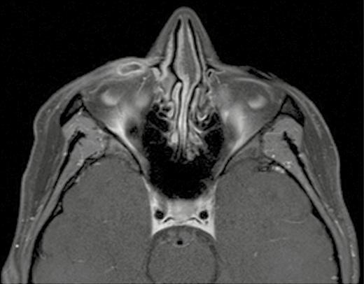 Contrast-enhanced T1-weighted magnetic resonance imaging scan of the orbit shows a thin walled cystic lesion.