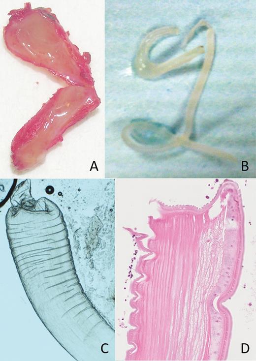 Sparganum removed from the lower eyelid. Panel A and B show the macroscopic features, whereas C and D (with H&E stain) are microscopic images.