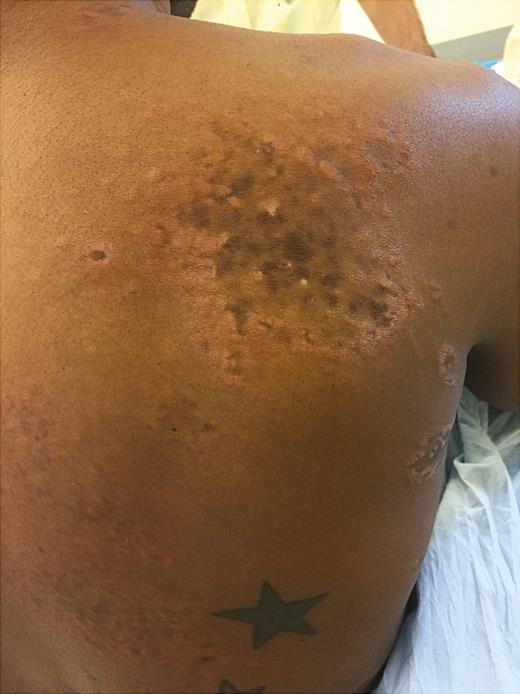 Single large skin lesion at the time of evaluation seen on patient’s back.