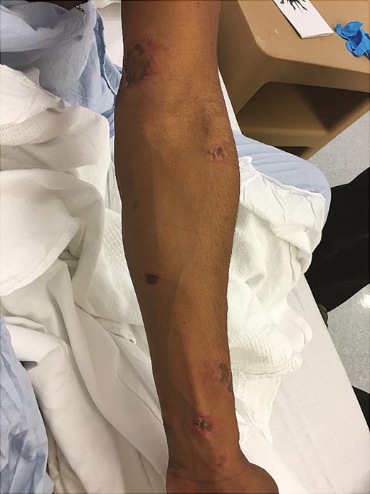 Ulcerated skin lesions at the time of evaluation seen on patient’s left arm.