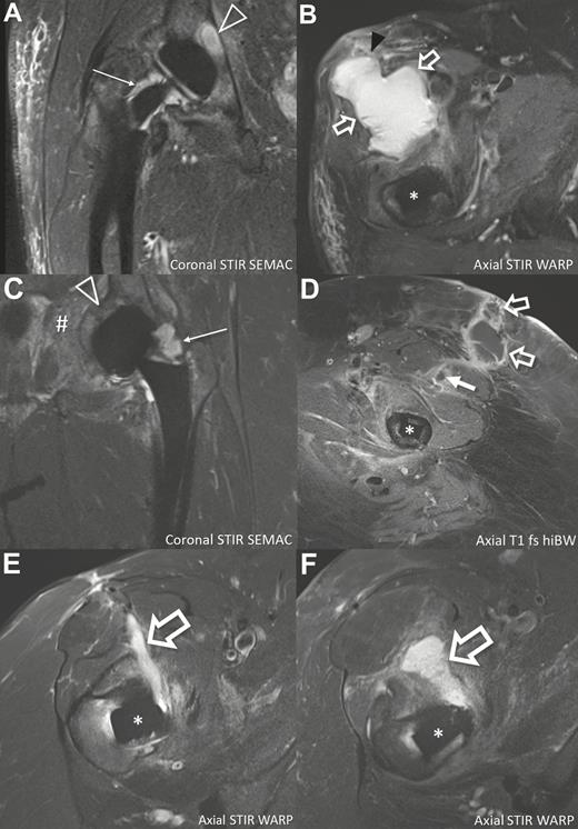 Spectrum of magnetic resonance imaging findings of 4 patients with Propionibacterium avidum prosthetic joint infections. A and B, An 81-year-old man (patient 4; Table 2) 2 years after total hip arthroplasty of the right hip. Coronal image demonstrates joint effusion (thin arrow) adjacent to the neck of the prosthesis and osteomyelitis (triangle) of the acetabulum. Axial image in the same patient shows large soft tissue abscess (outlined arrows) anterior to the hip joint breaking through the superficial muscle fascia (black arrowhead). C and D, A 53-year-old woman (patient 2) 6 months after total hip arthroplasty (THA) of the left hip. Coronal image demonstrates joint effusion (thin arrow) and extensive bone marrow edema in the acetabulum consistent with osteomyelitis (triangle). Furthermore, extension of the infection into the soft tissue of the pelvis is seen (#). Axial image after intravenous gadolinium administration at the level of the middle third of the femoral shaft shows anterior intramuscular abscess (solid arrow) and epifascial abscess (outlined arrows) extending to the dermis, with typical peripheral contrast enhancement. E, A 59-year-old woman (patient 1) 2 years after THA of the right hip with soft tissue abscess (outlined arrow) along the anterior surgical approach, extending to the femoral neck. F, A 64-year-old woman (patient 3) 19 days after THA of the right hip with soft tissue abscess (outlined arrow) along the anterior surgical approach, extending to the femoral neck. *Femoral component of THA. Abbreviations: fs, fat-saturated; hiBW, high readout bandwidth; SEMAC, slice-encoding for metal artifact correction; STIR, short tau inversion recovery; T1, T1-weighted; WARP, optimized inversion pulse.