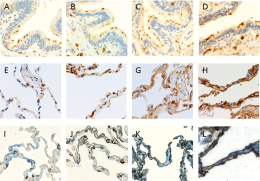 DPP4 protein expression in the bronchiolar epithelium and the alveolar tissues of never smoker, smoker, and COPD patients. Representative images of DPP4 staining in the bronchiolar epithelium (top row) and alveoli (middle and bottom row) of A,E,I, never-smoker, B,F,J, smoker without airflow limitation, C,G,K, subject with COPD GOLD stage II and D,H,L, subject with COPD GOLD stage III–IV. I–-L, are immunohistochemical stainings of DPP4 (brown) and aquaporin 5 (marker of type I alveolar epithelial cells) and pro-surfactant C (marker of type II alveolar epithelial cells) (both in blue). Co-staining of DPP4 with either one of the alveolar epithelial cell types results in a dark brown stain. DPP4 was mainly expressed in the alveolar epithelial cells and expressed the most intense in the COPD GOLD stage III–IV group. A 400× magnification was used for all photomicrographs in this figure. Abbreviation: COPD, chronic obstructive pulmonary disease; GOLD, global initiative for chronic obstructive lung disease.