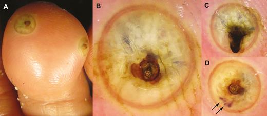 Clinical photographs (A) and dermoscopic image (B–D) of the patient’s feet. Arrow: dark-reddish wriggling tubular structure.