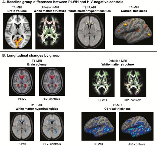 Summary of voxel-wise and vertex-wise neuroimaging results. A, Significant baseline differences between people living with human immunodeficiency virus (PLWH) and human immunodeficiency virus (HIV)–negative controls were seen in 4 neuroimaging modalities (displayed voxelwise or on the cortical surface). Highlighted regions indicate where PLWH showed lower brain volume (red-yellow areas), lower fractional anisotropy (red), higher white matter hyperintensities, and lower cortical thickness (red-yellow areas, left hemisphere displayed). B, Longitudinal data for these 4 neuroimaging modalities are displayed to illustrate significant changes between baseline and follow-up within each group. Longitudinal changes are seen for T1-weighted magnetic resonance imaging (MRI) with increased lateral ventricles volume (red areas) and reduced gray matter volume (blue areas). For diffusion MRI, reductions in fractional anisotropy (red-yellow) were observed, overlaid on the mean white matter “skeleton” (green) and an average fractional anisotropy image. For assessment of white-matter hyperintensities on T2-weighted fluid-attenuated inversion recovery (FLAIR), a moderate increase in average distribution was seen in both groups. For cortical thickness, changes are plotted on an inflated cortical surface (left hemisphere) for both groups.