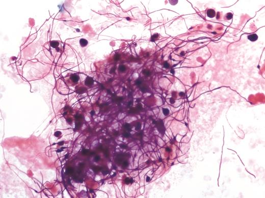 Filamentous, gram-variable organisms in a blood culture bottle that turned positive at 98 hours (magnification × 500).