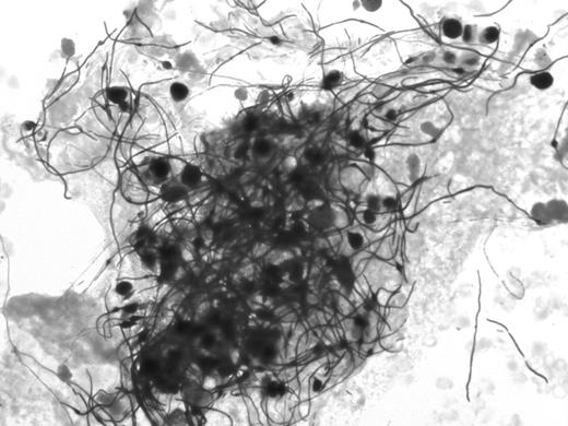 Filamentous, gram-variable organisms in a blood culture bottle that turned positive at 98 hours (original magnification, ×500).