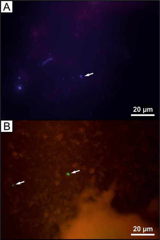 Microscopic examination of homogenized tissue from a patient with revision total hip arthroplasty. A, Single microsporidial spore (arrow) stained with Calcofluor M2R. B, Encephalitozoon cuniculi spores (arrows) labeled with anti–outer spore wall epitopes fluorescein–conjugated polyclonal antibodies.