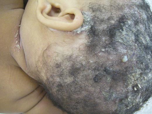 Dermatological lesions of a representative infective dermatitis associated with Human T-cell Lymphotropic Virus Type-1 (IDH) patient. Dermatological aspects of an IDH 2-years-old female with an extensive erythematous-scaly lesion covered with adherent yellowish crusts involving the scalp, the retroauricular region and the neck. Abbreviation: IDH, infective dermatitis associated with Human T-cell Lymphotropic Virus Type-1.