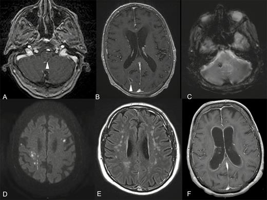 Main patterns of radiological neurolisteriosis in magnetic resonance imaging (MRI) procedures. A, Axial contrast-enhancing T1-weighted MRI with a ring-like enhancing pons image corresponding to an abscess (arrow head). B, Axial contrast-enhancing T1-weighted MRI with a ring-enhancing image of the right parietal lobe corresponding to an abscess (arrow head) with diffuse meningeal enhancement. C, Axial T2 gradient-echo MRI with markedly hypo signal in right cerebellar peduncle corresponding to focal bleeding. D, Axial diffusion weighted MRI with bilateral supra-tentorial cerebral dot-like hyper signals corresponding to ischemic images highly evocating of radiological vasculitis. E, Axial T2 spin-echo MRI with symmetric hyper signals of supra-tentorial white matter. F, Axial contrast-enhancing T1-weighted MRI with hydrocephalus and ventricular ependymal lining enhancement.