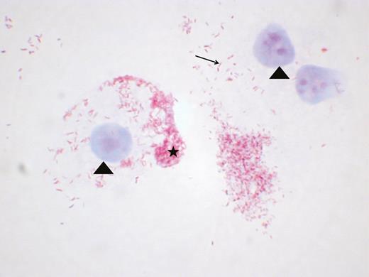 Positive culture of Coxiella burnetii in acute Q fever endocarditis from a blood sample. Coxiella burnetii is a gram-negative fastidious intracellular bacterium that needs cells to multiply; the blood was therefore seeded directly onto L929 cells in a Biosafety Level 3 laboratory and culture was started 3 weeks later. L929 cells and nucleus are colored with the malachite green colorant (arrowhead). Coxiella burnetii bacteria are pink-colored by the fuchsine colorant. Coxiella burnetii is identified as a unique bacterium (arrow) and is concentrated in intracytoplasmic vacuoles (star). Gimenez coloration, magnification ×100.