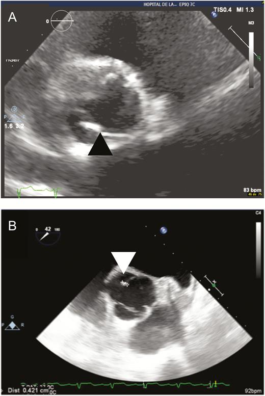 Acute Q fever endocarditis. A, Parasternal transthoracic echocardiography zooms in on the aortic valve, showing a tricuspid aortic valve with the presence of a hyperechogenic valvular nodular thickening lesion on the noncoronary sigmoid valve (black arrowhead). B, Transesophageal echocardiography (45°) zooms in on the aortic valve, confirming the presence of a 4-mm nodular lesion on the noncoronary sigmoid (white arrowhead).