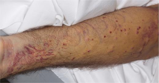 Erythematous papules and nodules on the left forearm of a 40-year-old man after 30 days of neutropenia.