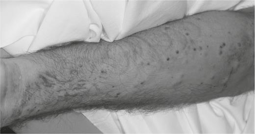 Erythematous papules and nodules on the left forearm of a 40-year-old man after 30 days of neutropenia.