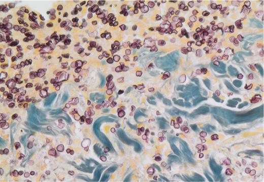 Grocott methenamine silver stain from a single nodule (×40 magnification). Budding yeast cells are visible in the subcutaneous tissue with associated necrotic debris mixed with neutrophils.